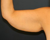 Arm Lift San Diego 27 - before
