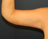 Arm Lift San Diego 27 - after