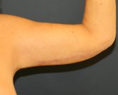 Arm Lift San Diego 28 - after