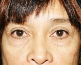 Blepharoplasty Case 2 - before