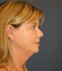 Neck Lift San Diego 38 - before