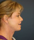 Neck Lift San Diego 38 - after