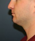 chin implant neck lipo - before