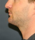 chin implant neck lipo - after
