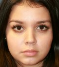 Tip Rhinoplasty in Office - after