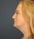 Face, Neck, Eyes, Laser - before