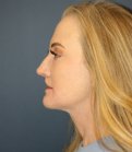 Face, Neck, Eyes, Laser - after