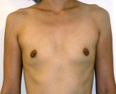 Breast Augmentation Case 22 - before