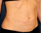 Tummy Tuck San Diego 120 - before