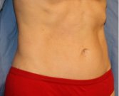Tummy Tuck San Diego 120 - after