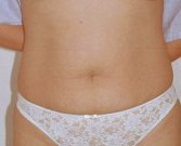 Tummy Tuck Case 2 - before