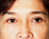 Blepharoplasty Case 2 - after