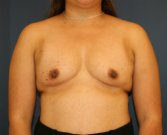 Breast Augment 540cc saline - before