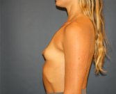breast augment 400cc - before