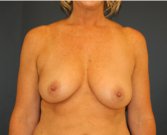 Areola Lift with Breast Implants - before