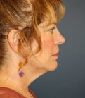 Neck Lift Surgery San Diego - before