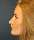 Revision Rhinoplasty 28 - before