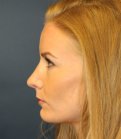 Revision Rhinoplasty 28 - after