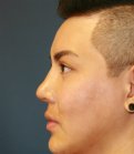 Revision Rhinoplasty 39 - after