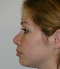 Two Weeks After Revision - before