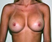 Breast Augmentation Case 24 - after