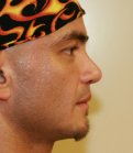 Cleft Lip Nose Revision - after