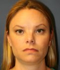Revision Rhinoplasty 12 - before