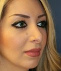 Nostril Reduction - before