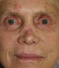 87 yr old nose revision - before