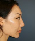 Nose Revision 25 - before