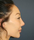 Nose Revision 25 - after