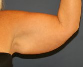 Arm Lift San Diego30 - before