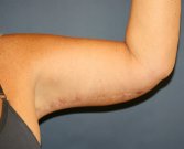 Arm Lift San Diego30 - after