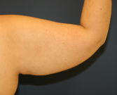Arm Reduction 33 - before