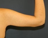 Arm Reduction 33 - after