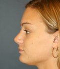 Rhinoplasty San Diego 134 - after