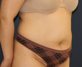 Tummy Tuck San Diego 145 - before