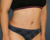Tummy Tuck San Diego 145 - after