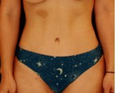 Tummy Tuck San Diego 146 - after