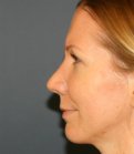 Rhinoplasty San Diego 135 - after