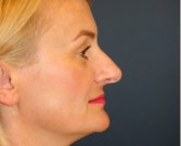 Rhinoplasty San Diego 136 - before