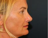 Rhinoplasty San Diego 136 - after