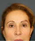 Browlift trans brow - before