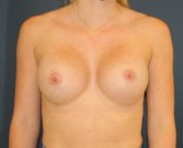 415cc Breast Augmentation - after
