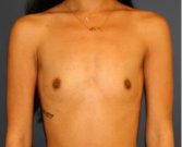 Breast Augmentation 126 - before