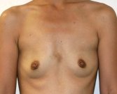 Breast Augmentation Case 28 - before