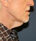Necklift 201 - before