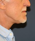 Necklift 201 - after