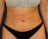 Tummy Tuck 201 - before