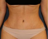 Tummy Tuck 201 - after